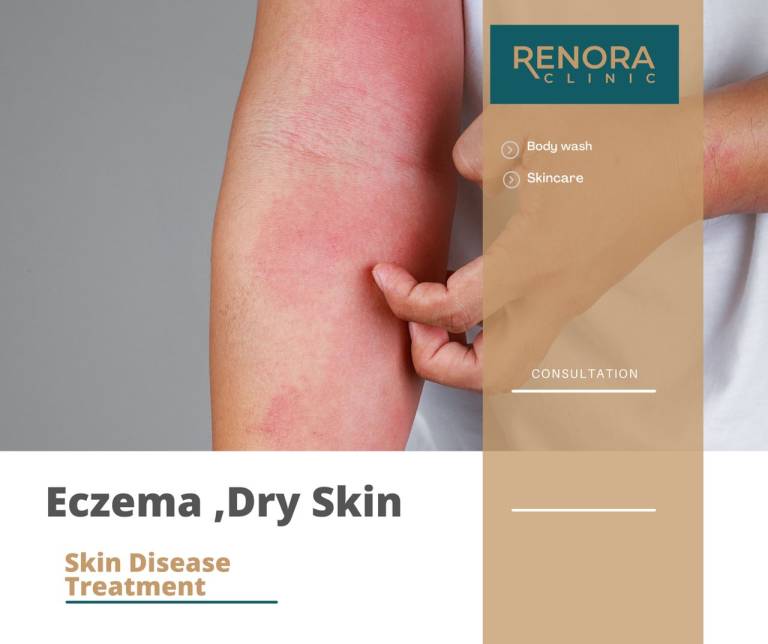 PROMO - ECZEMA AND DRY SKIN