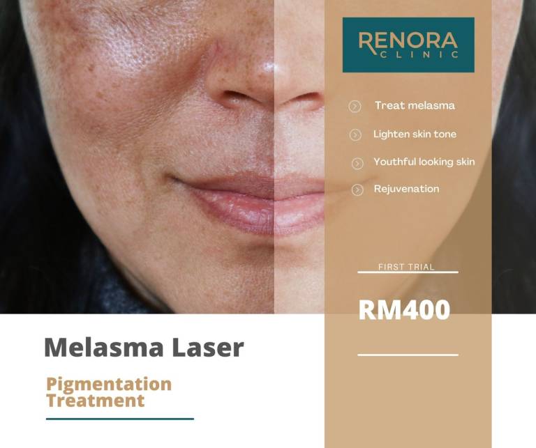 PROMO - MELASMA LASER