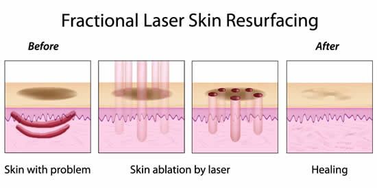 Rawatan Fractional Laser