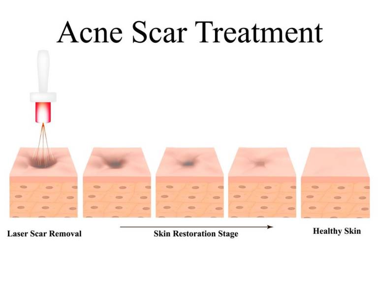 Proses Recovery Selepas Fractional Laser