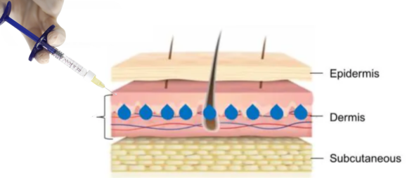 Rejuran Injection Site
