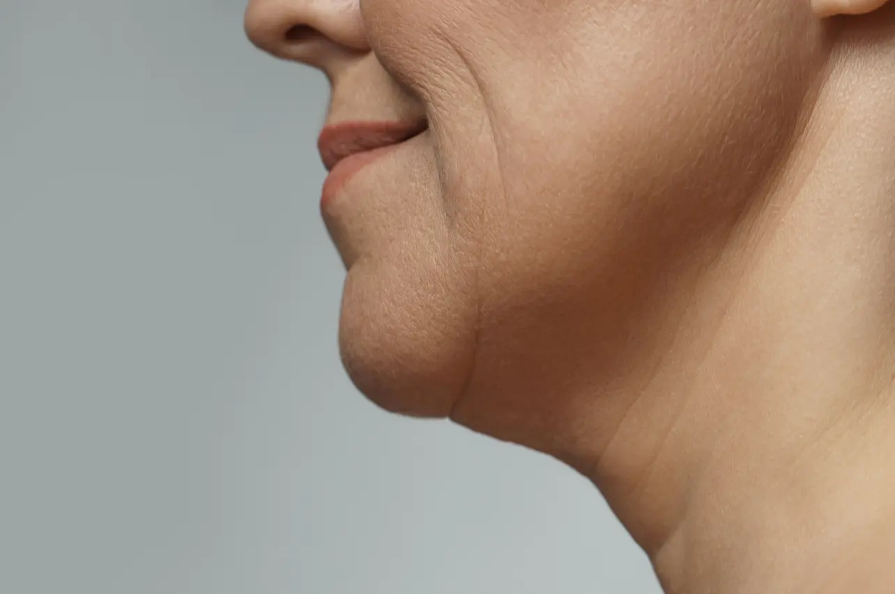 Sagging skin and facial laxity