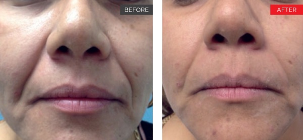 Fotona Before After 3