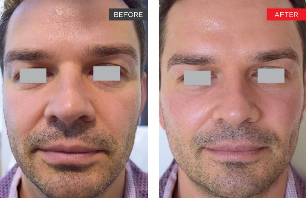 Fotona Before After 7