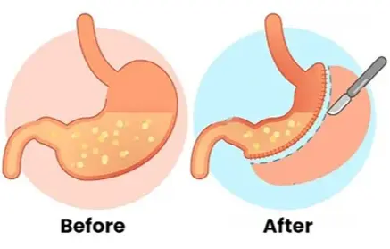 Bariatric Surgery image