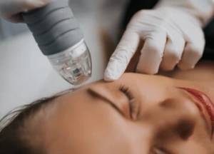 microneedling