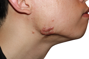 parut keloid scar