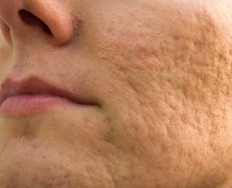 Acne scars and uneven skin texture