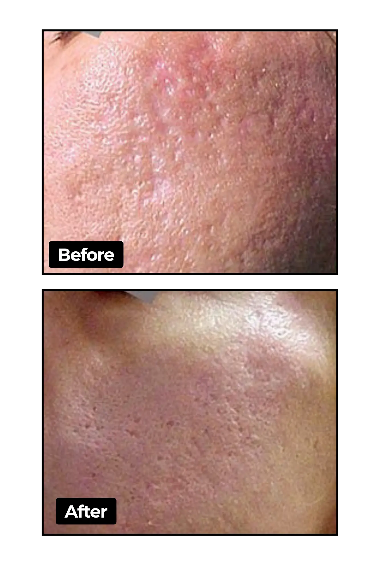 Fotona laser results
