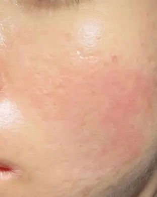 Treatment results