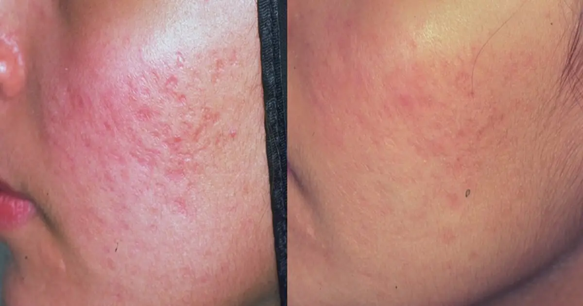CO2 Laser results - before and after
