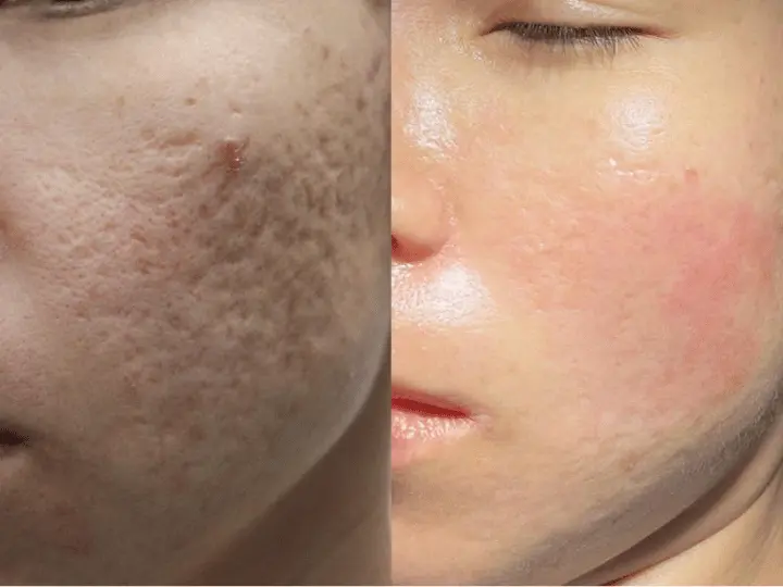 Before and after acne scar treatment
