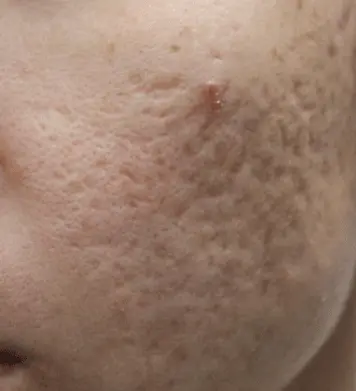 Close-up scar texture