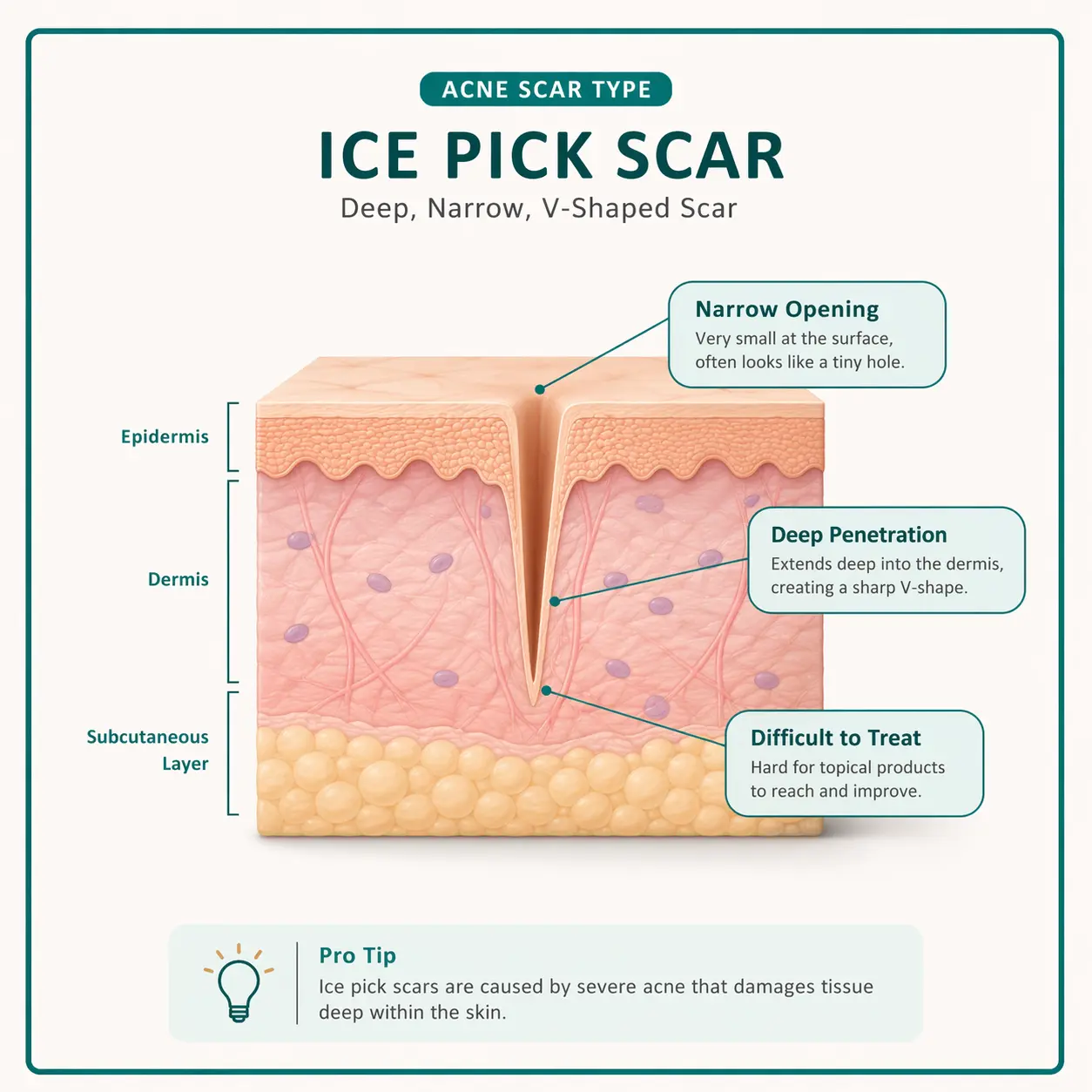 Ice Pick Scars