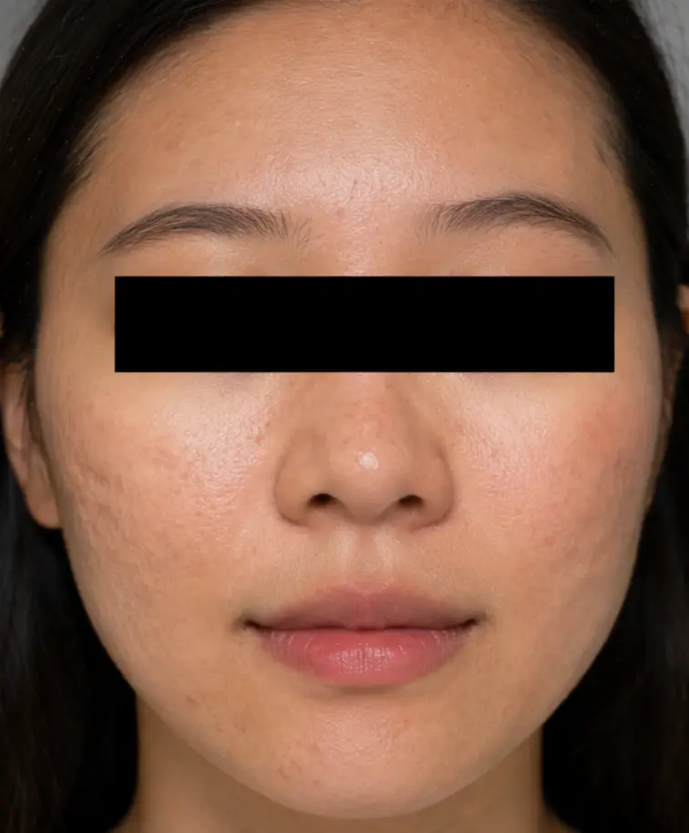 After Microneedling at Renora Clinic