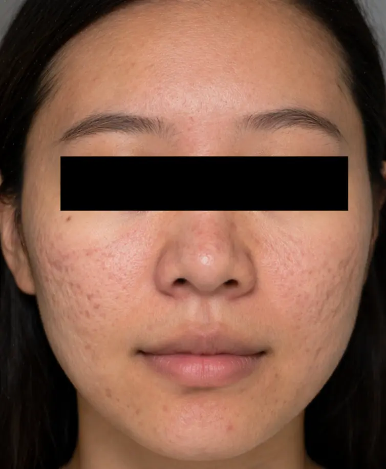 Before Microneedling at Renora Clinic