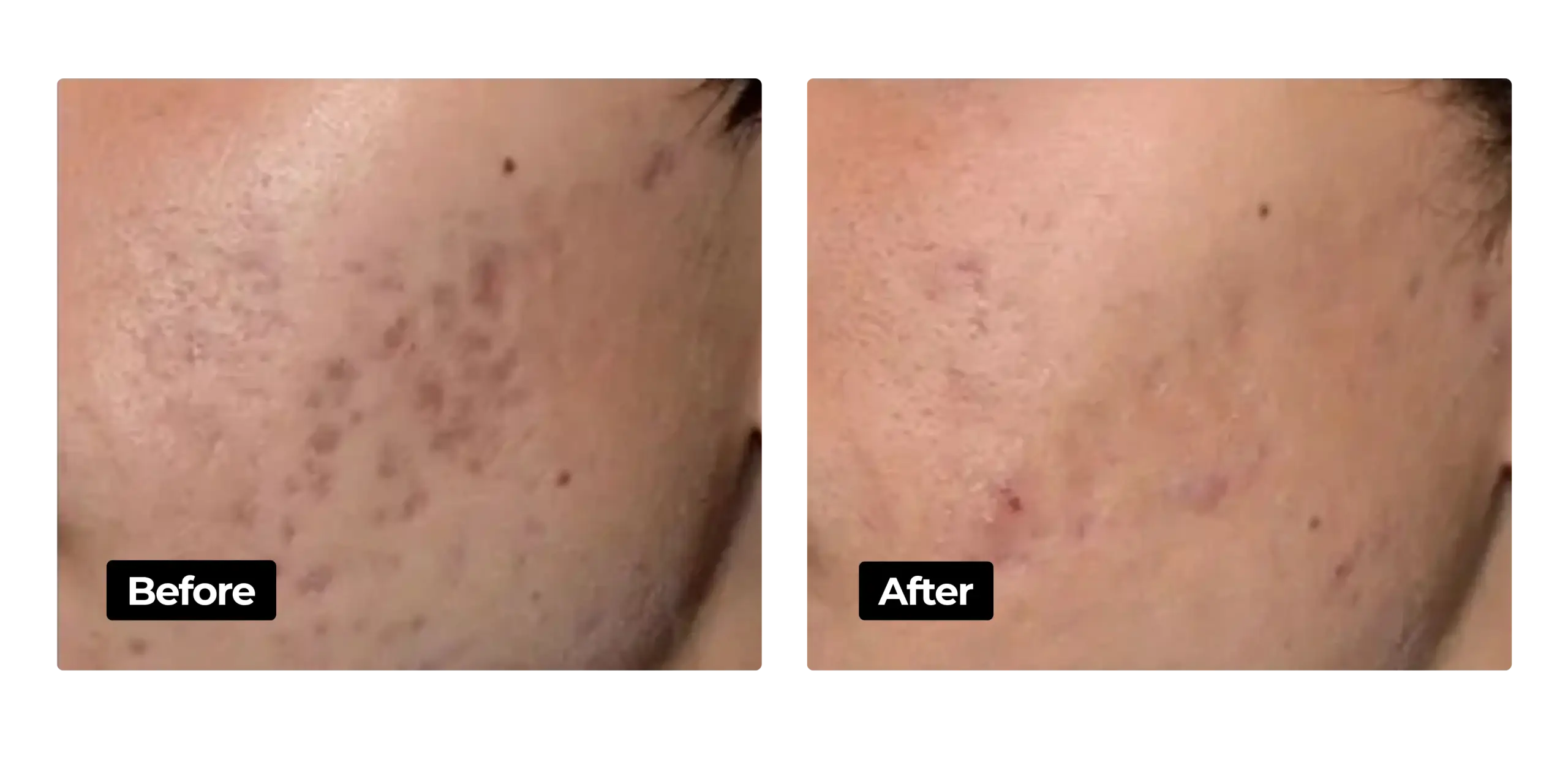 PIH treatment results