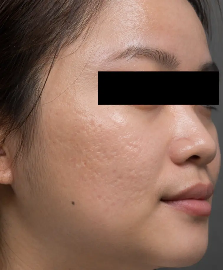 After Subcision at Renora Clinic