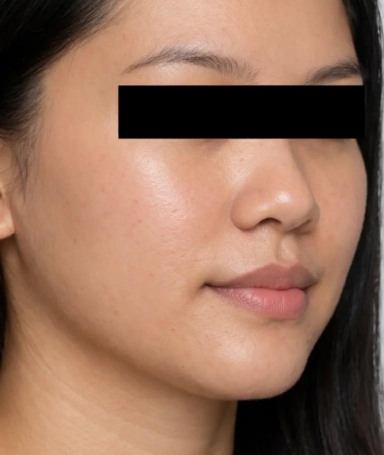 After TCA Cross treatment at Renora Clinic