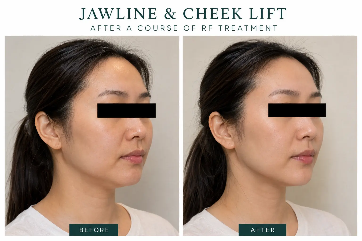 RF treatment before and after — firmer jawline and reduced saggy skin after a course of sessions