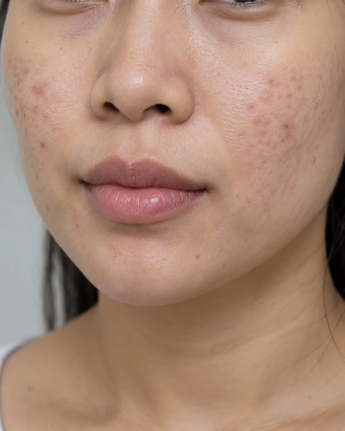Close-up image showing acne marks and acne scars