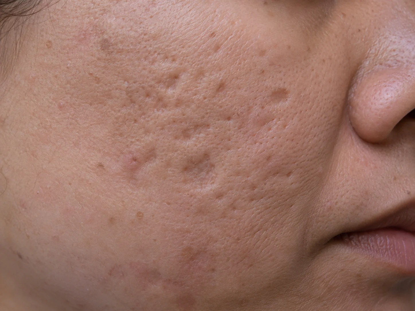 Close-up of boxcar acne scars with wider depressions