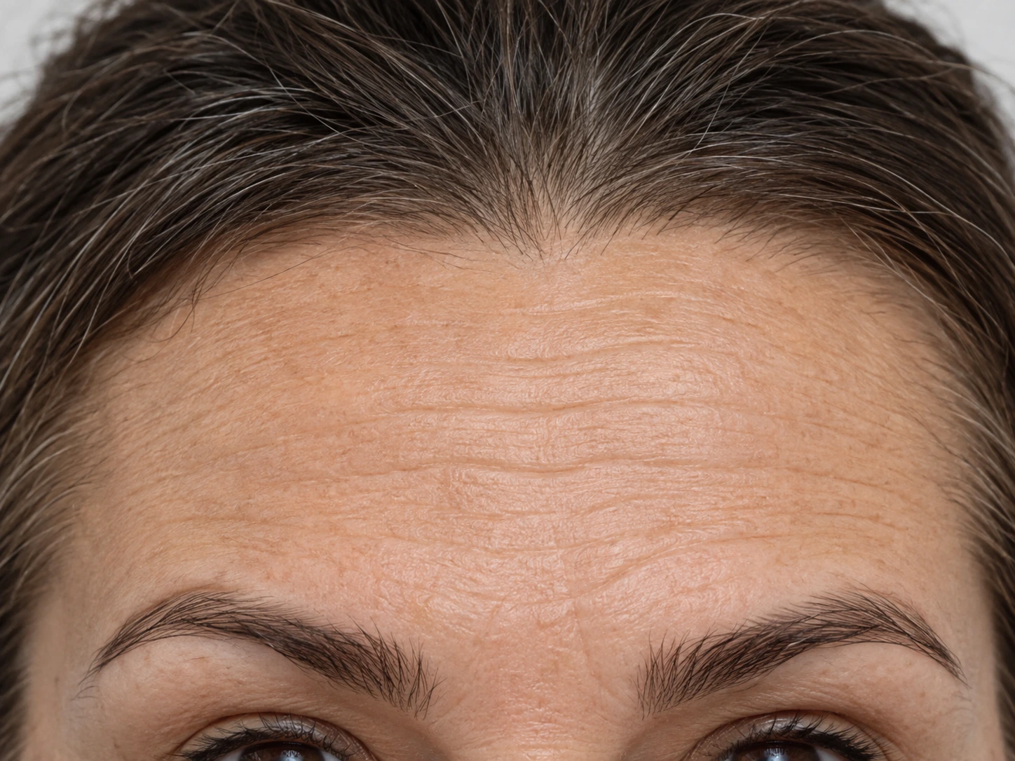 Forehead expression lines and wrinkles