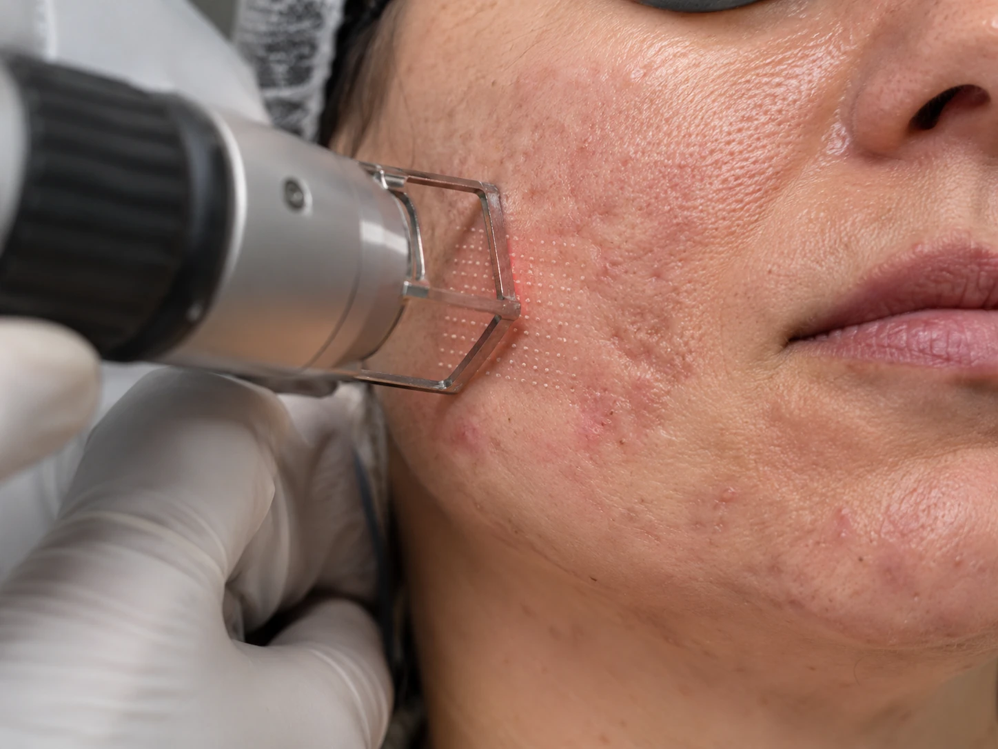 Fractional CO2 laser acne scar treatment at Renora Clinic