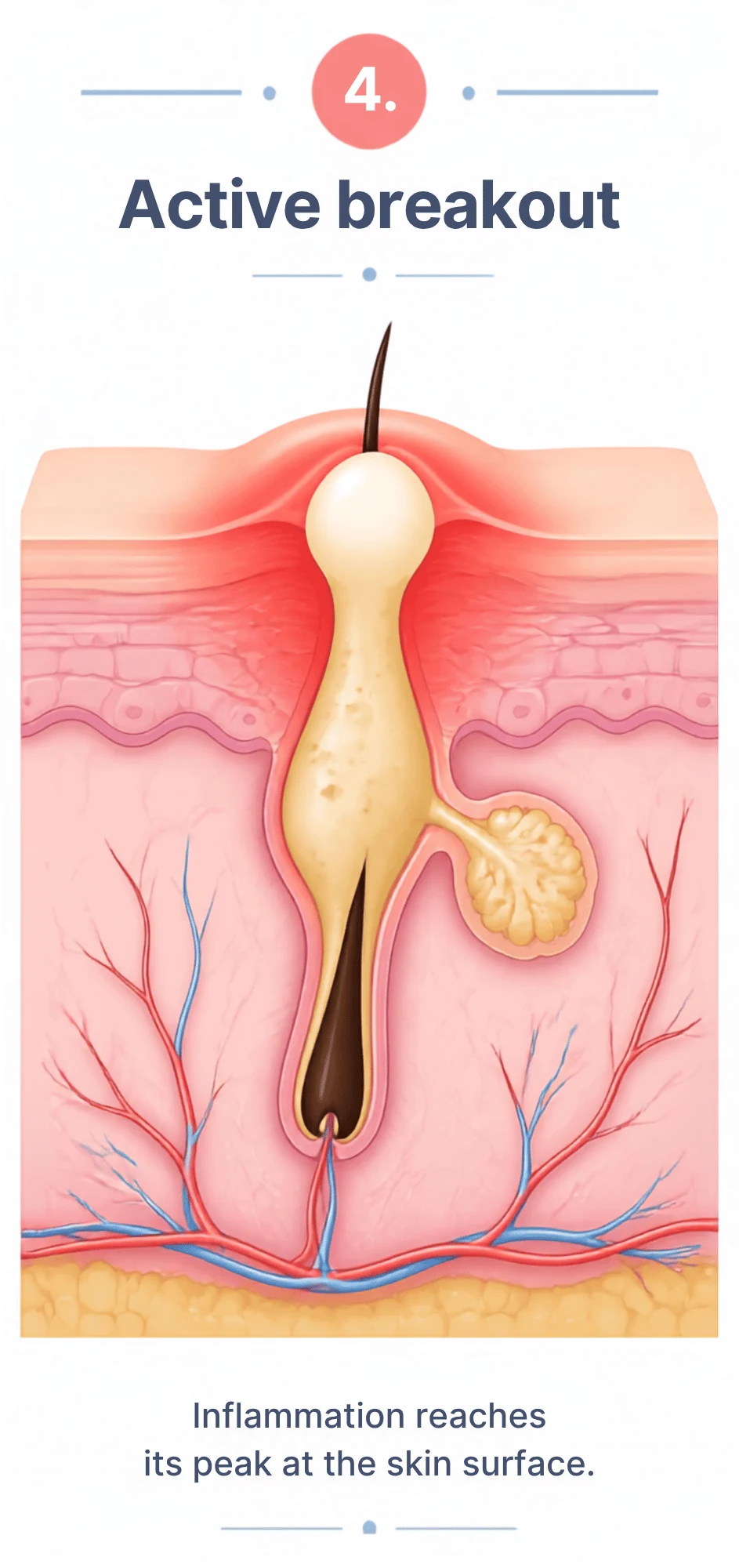 Illustration of an active acne breakout at the skin surface