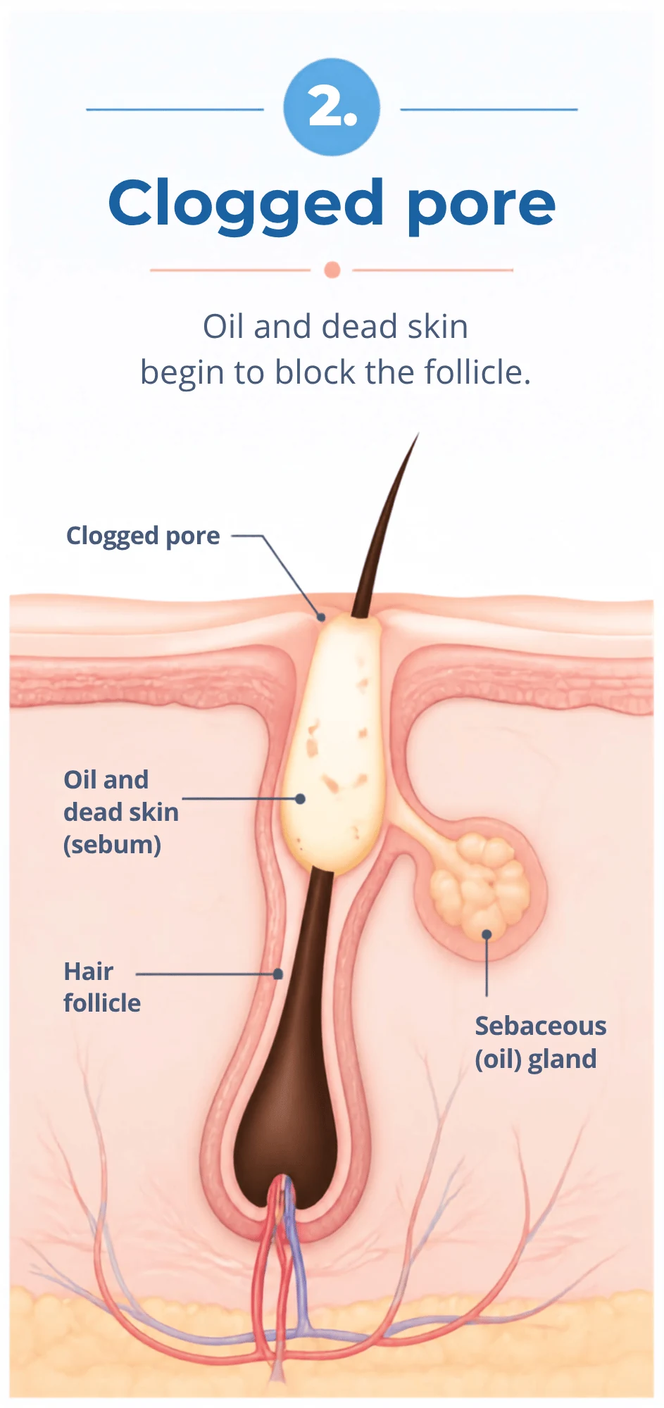 Illustration of oil and dead skin clogging a hair follicle