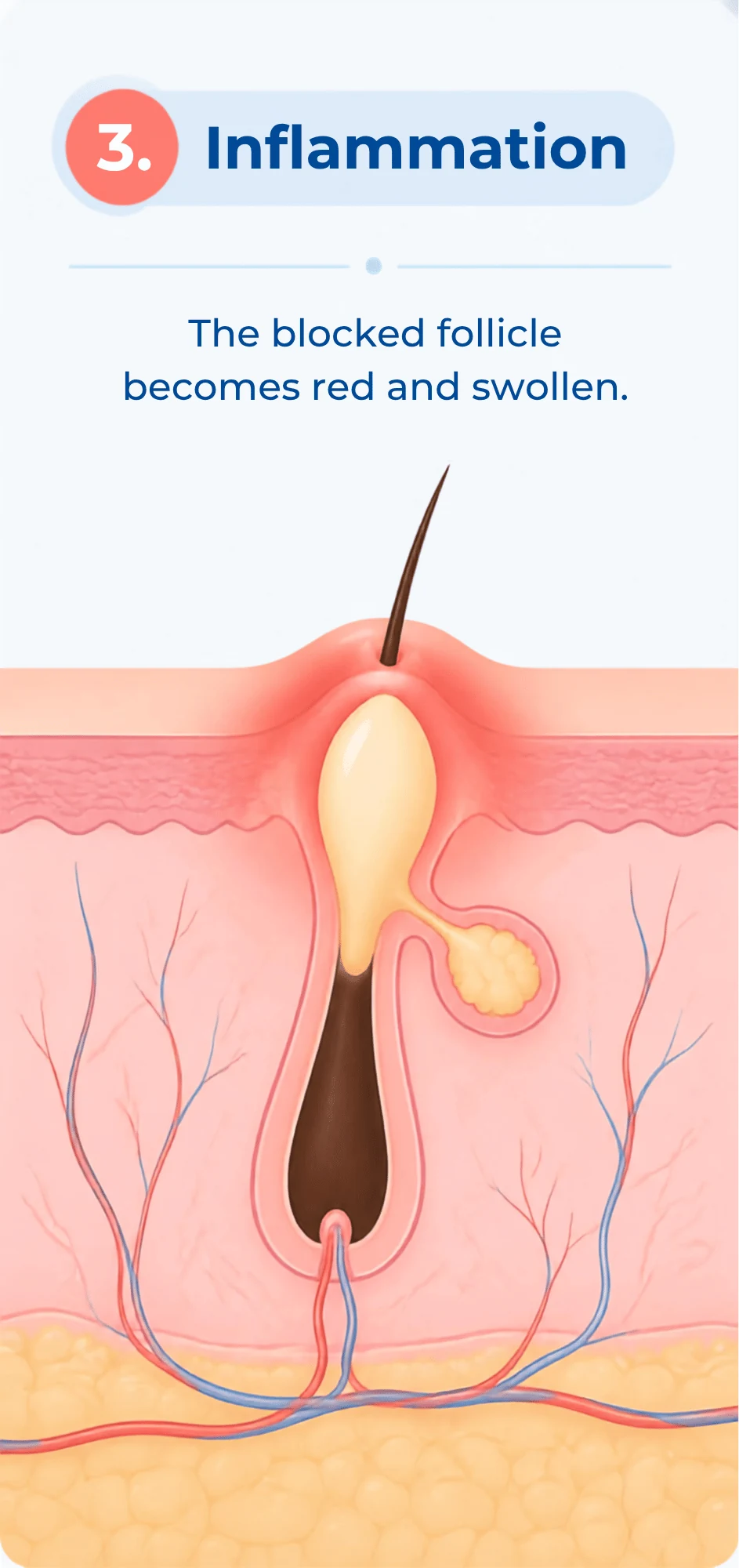 Illustration of an inflamed and swollen blocked skin follicle