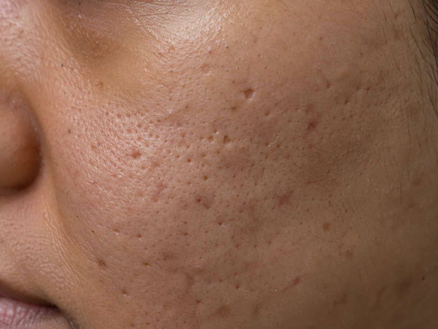 Close-up of deep narrow ice pick acne scars