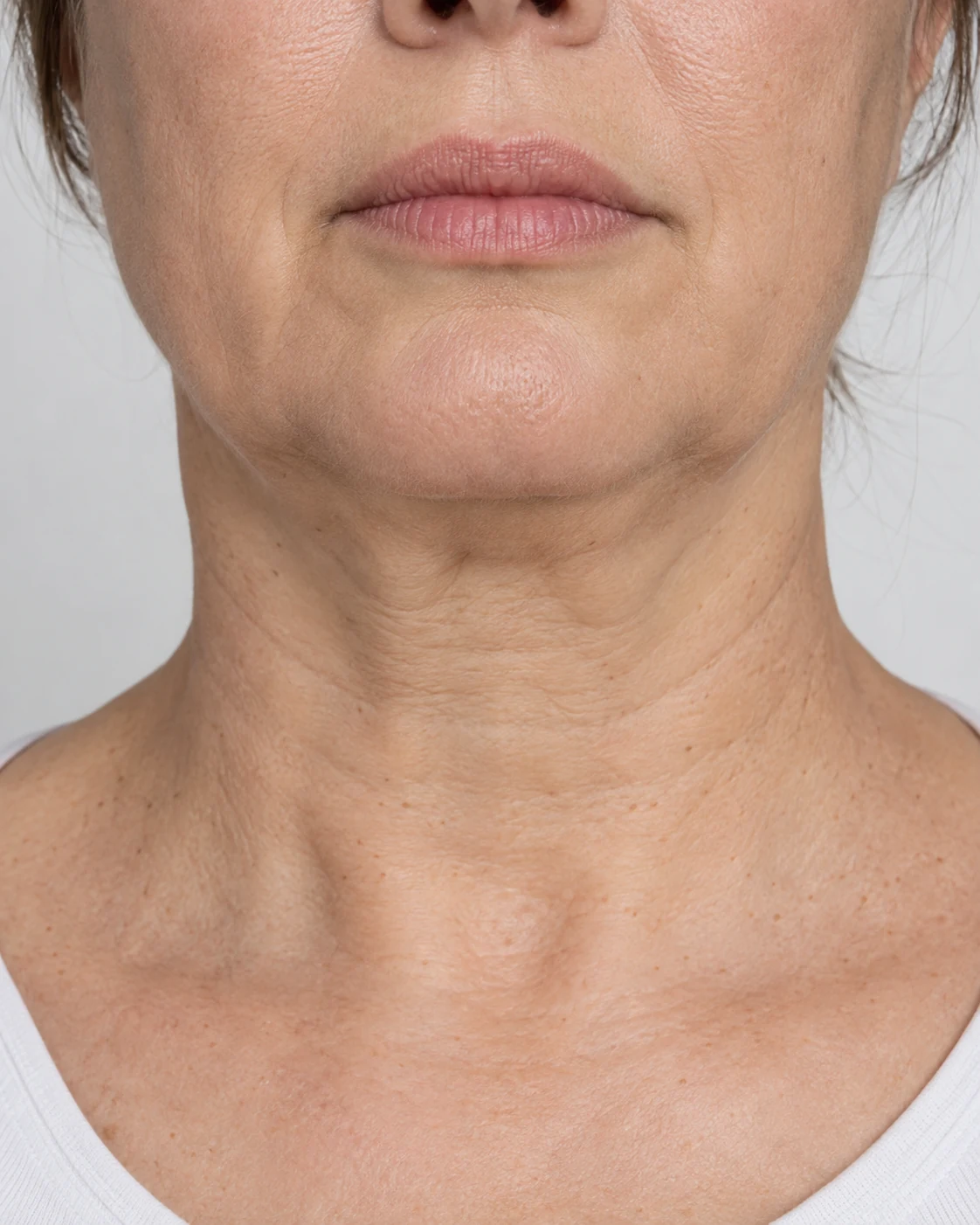 Common lower face and neck areas affected by skin ageing