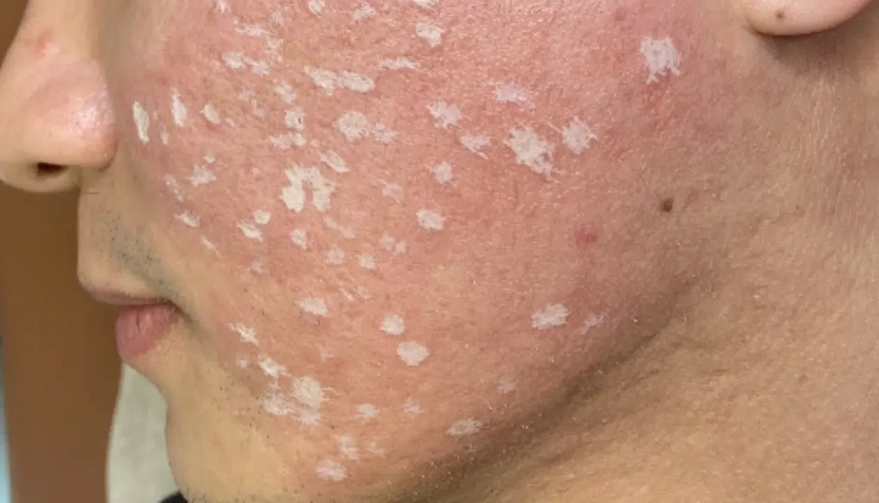 TCA CROSS treatment for selected acne scars at Renora Clinic