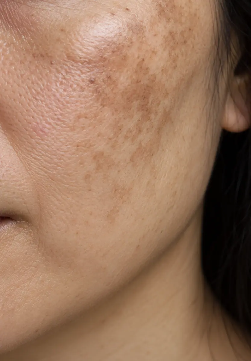 Melasma pigmentation on facial skin
